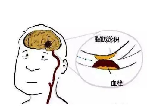 這些卒中信號是大腦最后的呼救