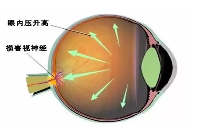 致盲率極高，青光眼呈現(xiàn)年輕化趨勢