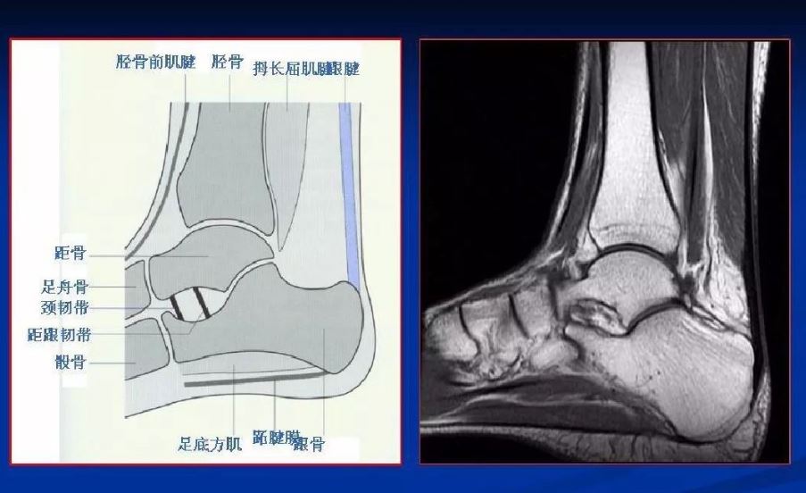 扭了腳脖子怎么還得做核磁？