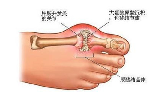 痛風(fēng)不痛時(shí) 別不當(dāng)回事